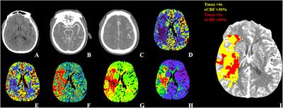 Multimodal CT Imaging Characteristics in Predicting Prognosis of Wake-Up Stroke